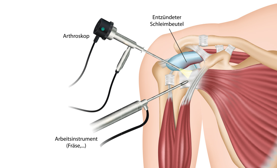arthroskopie-minimalinvasive-chirurgische-behandlung
